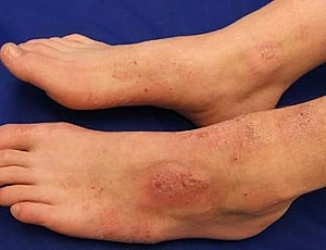 15 meilleurs remèdes contre l'eczéma